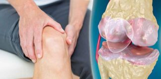 Τι είναι η οστεοαρθρίτιδα; Οστεοαθρίτιδα Γόνατος